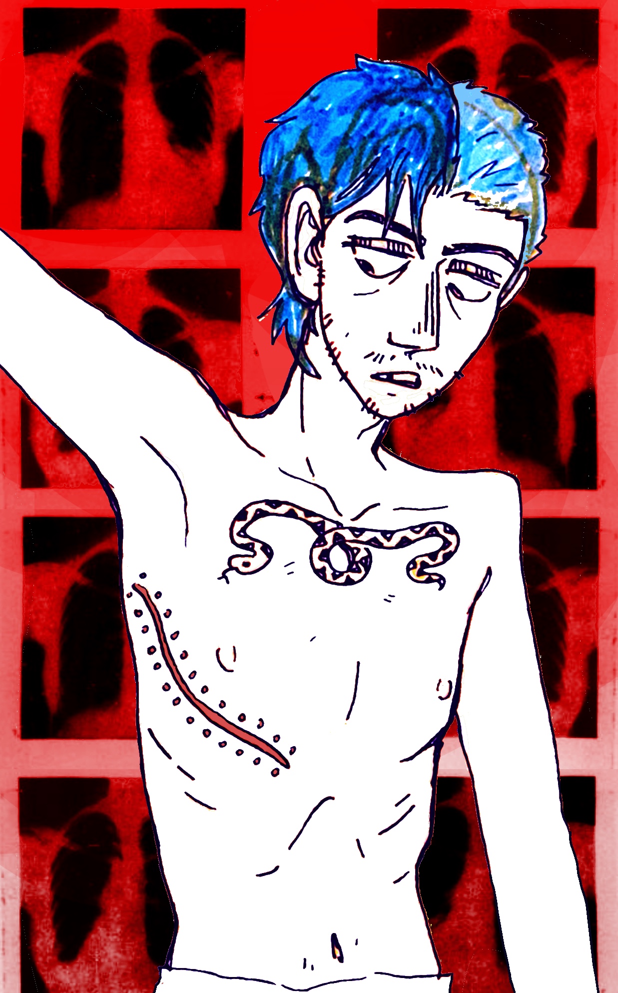 Nikita showing his lung surgery scar